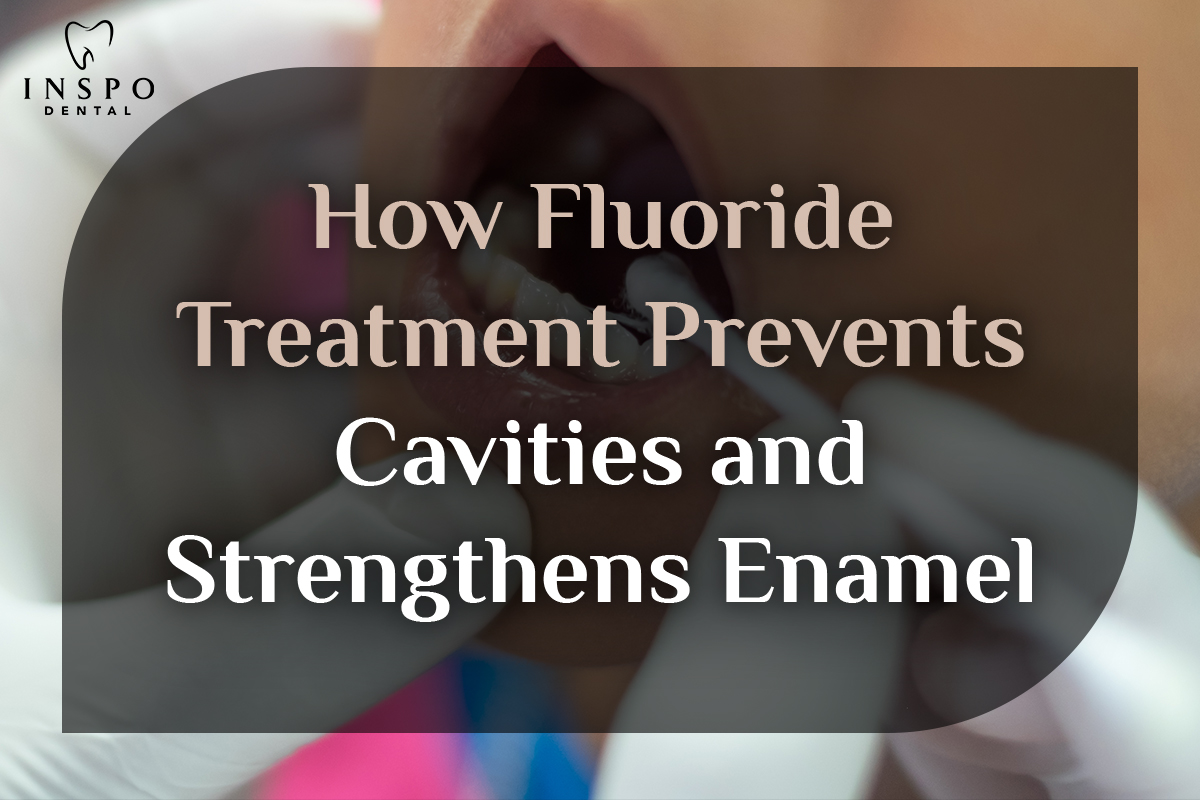 How-Fluoride-Treatment-Prevents-Cavities-and-Strengthens-Enamel